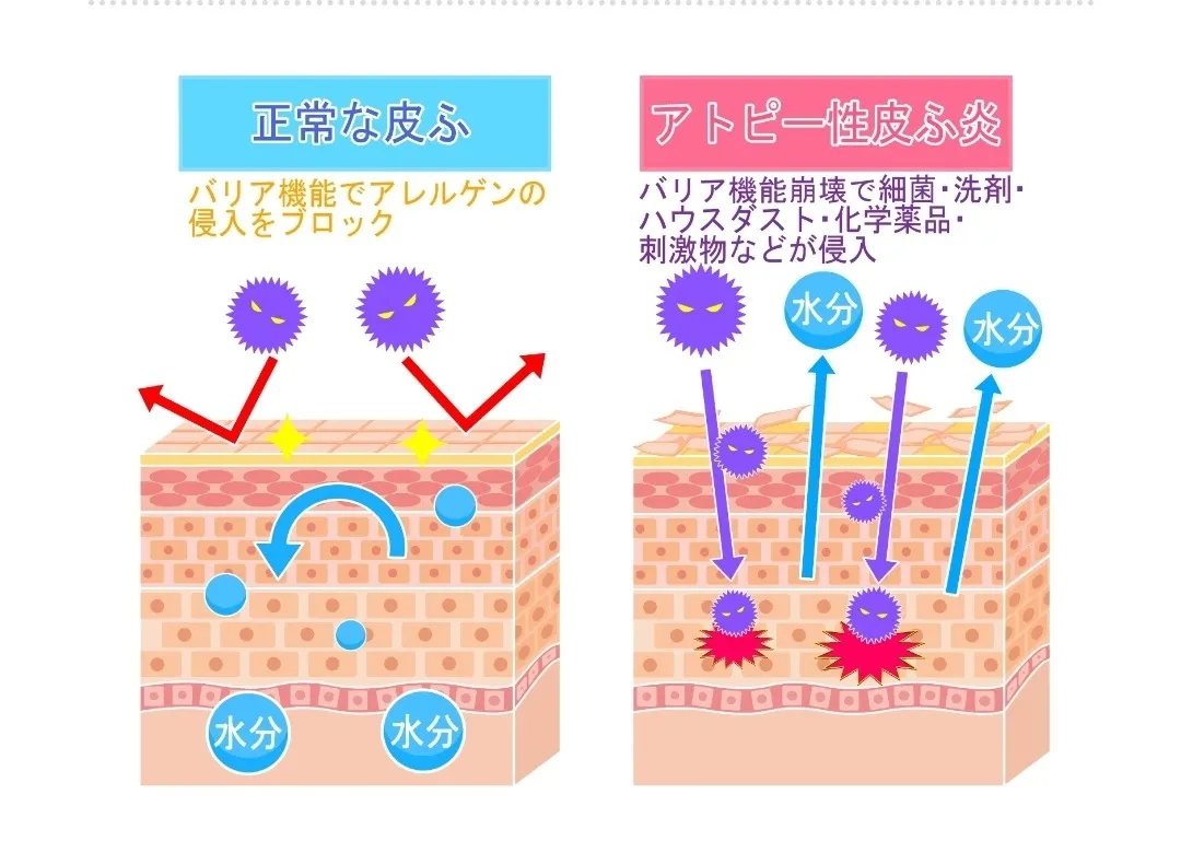 【効果】アトピー性皮膚炎に黄土よもぎ蒸し